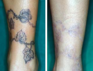 Tattoo vor und nach der Behandlung
